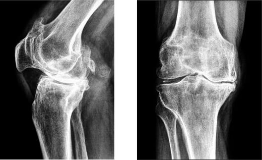 Gonartrose da articulação do joelho em radiografia