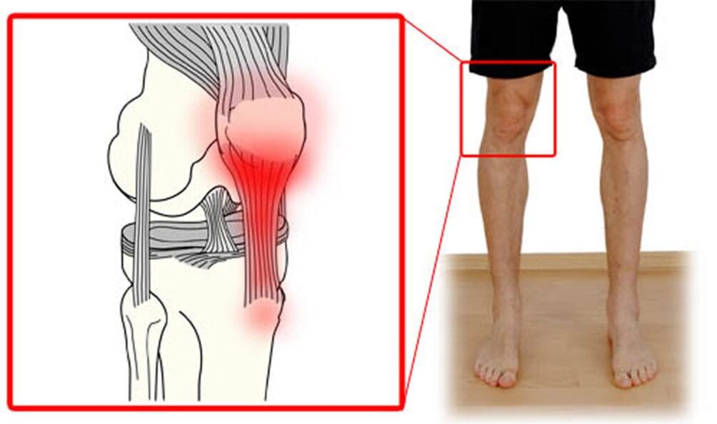 Tendinite – inflamação dos tendões da articulação do joelho