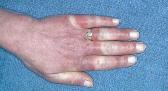 Quadro clínico da síndrome de Raynaud - vasoespasmo, hiperemia, edema