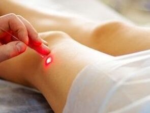 Tratamento da artrose da articulação do joelho com um laser